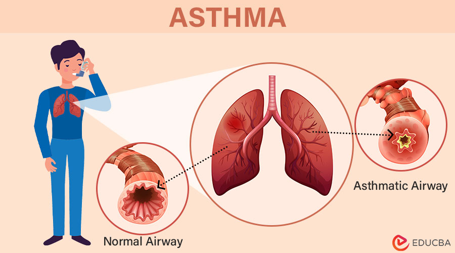 What is Asthma