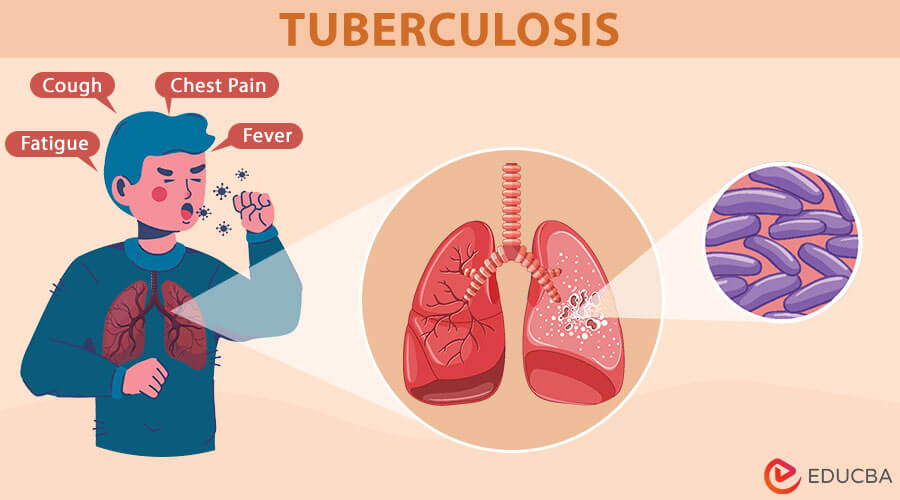 What is Tuberculosis? Causes, Transmission & Treatment