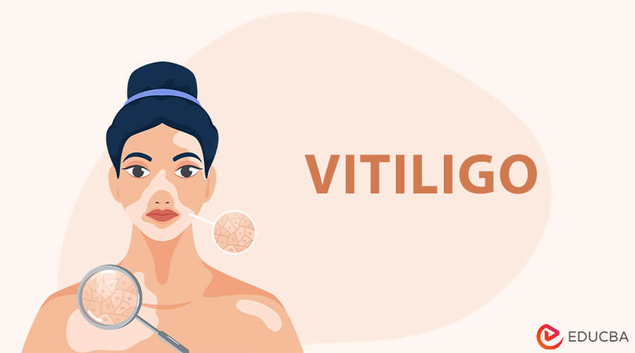 Vitiligo