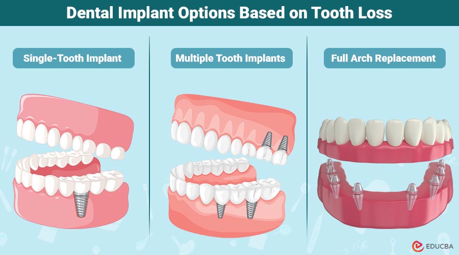 Dental Implant